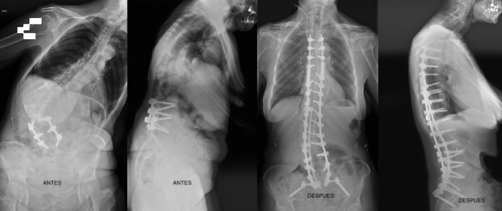 Diseño De La Estructura: Barras, Conectores Y Fatiga